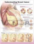 Understanding Breast Cancer Anatomical Chart, 2nd Edition